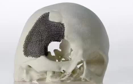 顱骨3D打印技術是什么？